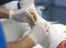 queimadura-768×512-1